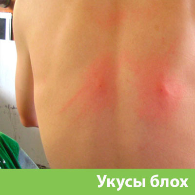 Укусы блох в Еманжелинске
