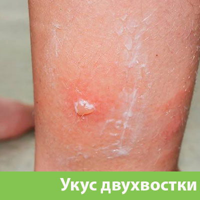 Укус двухвостки в Еманжелинске