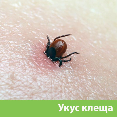 Укус клеща в Еманжелинске