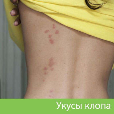 Профессиональное уничтожение клопов в Еманжелинске